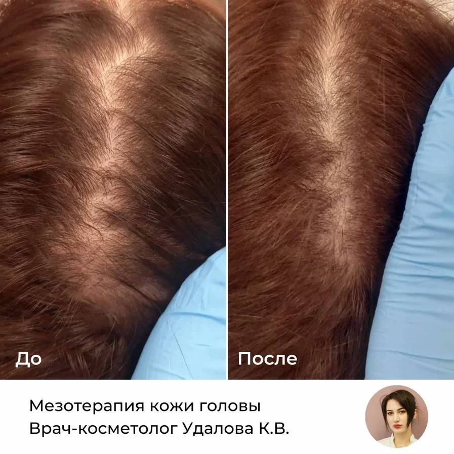 Мезотерапия для волос