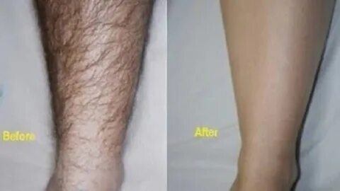 Лазерная эпиляция диодным лазером "Diolaze" зона ноги (мужчины)