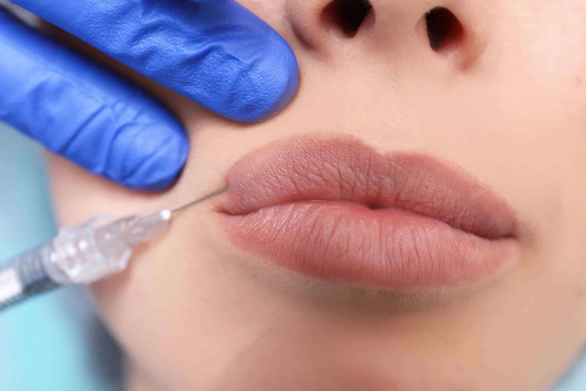 Контруная пластика губ препаратом Belotero Lips Contour 0,6 мл
