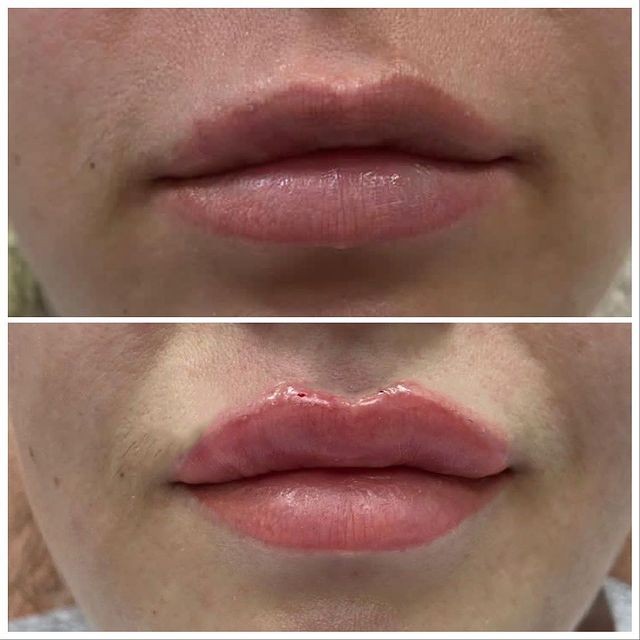 Увеличение губ препаратом Belotero Lips Shape