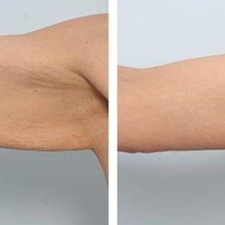 BBL омоложение Skin Tyte – Внутренняя поверхность руки (парная зона)