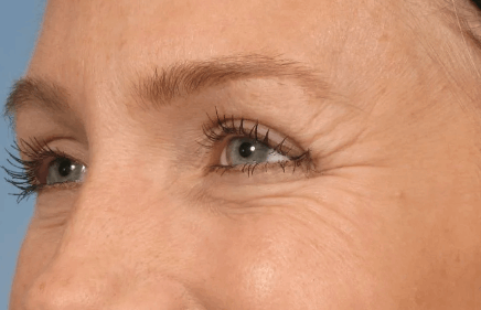 Коррекция мимических морщин: зона вокруг глаз (Диспорт, 50 ед)