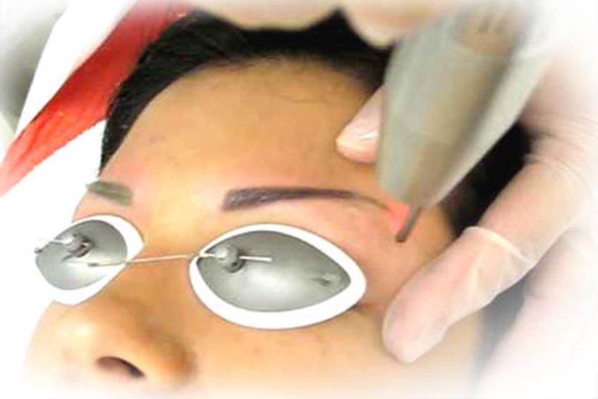 Удаления татуажа на неодимовом лазере брови полностью (анестезия входит в стоимость)