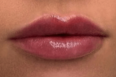Увеличение губ препаратом Belotero Lips Shape (0,6 мл)