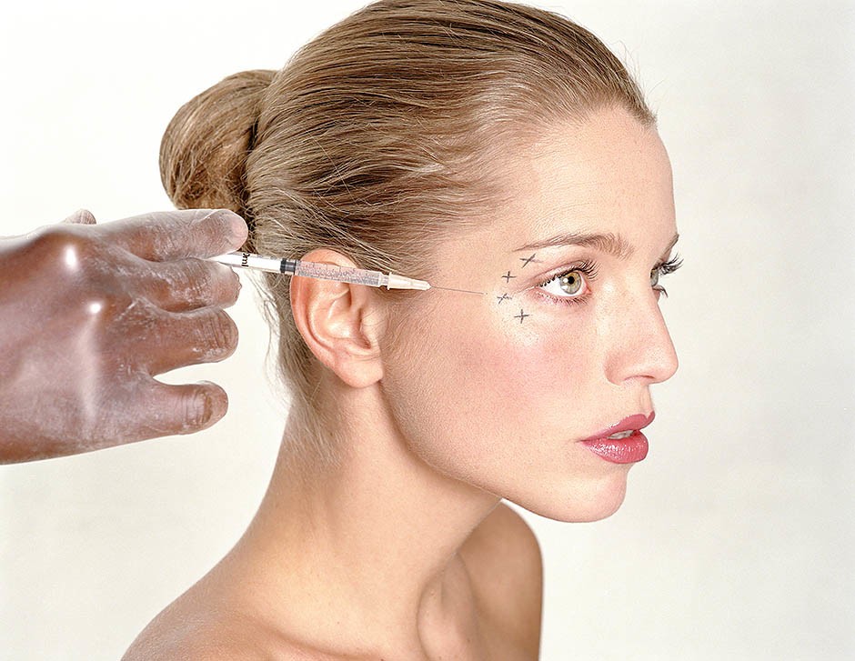 Коррекция мимических морщин препаратом Botox зона вокруг глаз (12 ед)