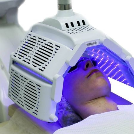 Фотодинамическая терапия лица, лечение акне/розацеа (Revixan Duo Light)