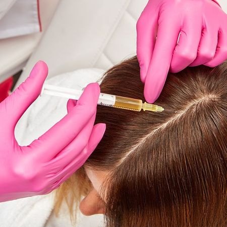 Плазмотерапия волосистой части головы
