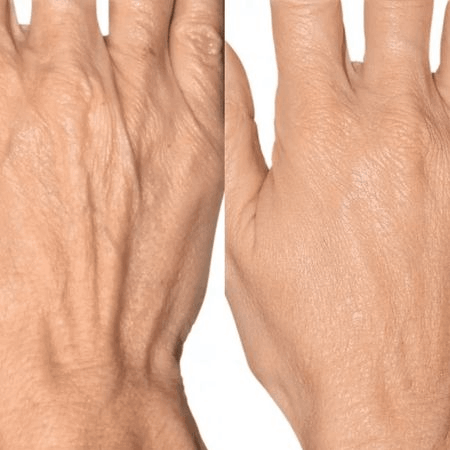 Фототерапия кожи BBL – Кисти рук