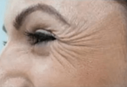 Коррекция мимических морщин препаратом Relatox: глаза (15-20 ед)