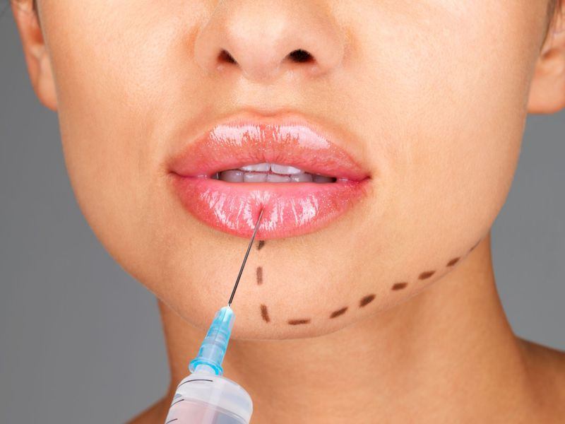 Увеличение губ препаратом Art Filler Lips  (1 мл)