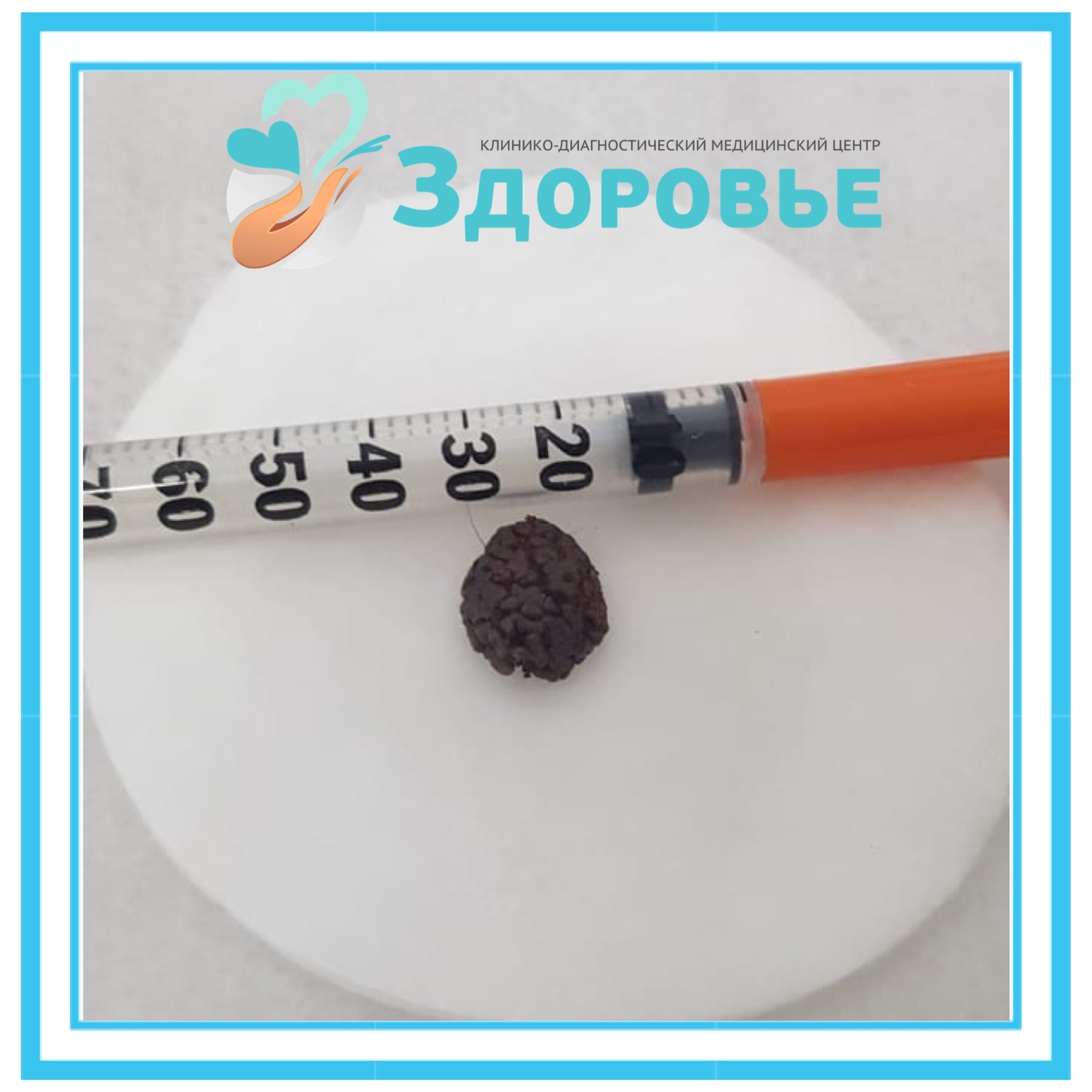 Радиоволновое удаление бородавки до 0.5 см - до 3 шт