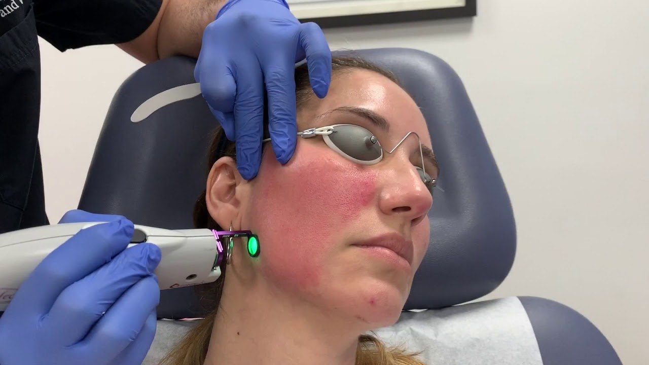 Лечение розацеа (купероза) на аппарате V-beam/Candela: лицо