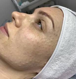 Биоревитализация препаратом Viscoderm 1,6% (1,5 мл)