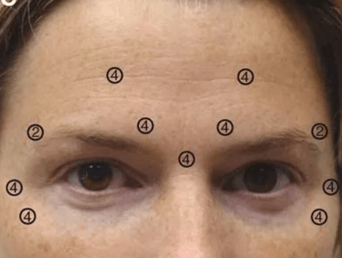 Коррекция мимических морщин: лоб + межбровье + зона вокруг глаз (Диспорт, 100 ед)