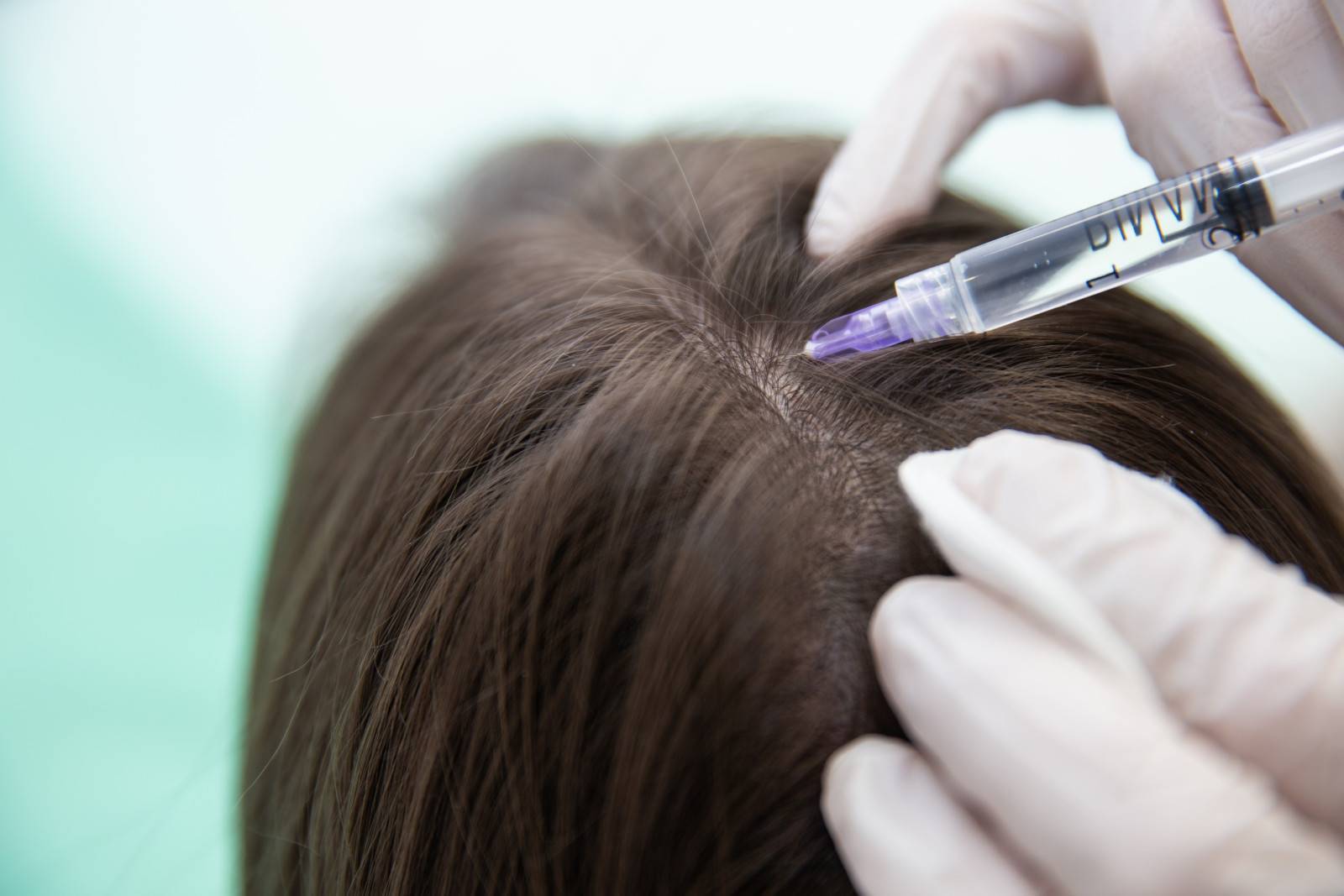 Плазмотерапия, волосистая часть головы