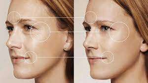 Биоревитализация кожи лица препаратом Revi Silk 1мл.