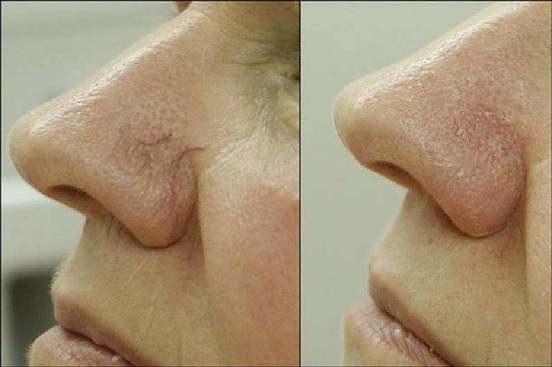 Лечение сосудистых образований на лице (купероз) крылья носа