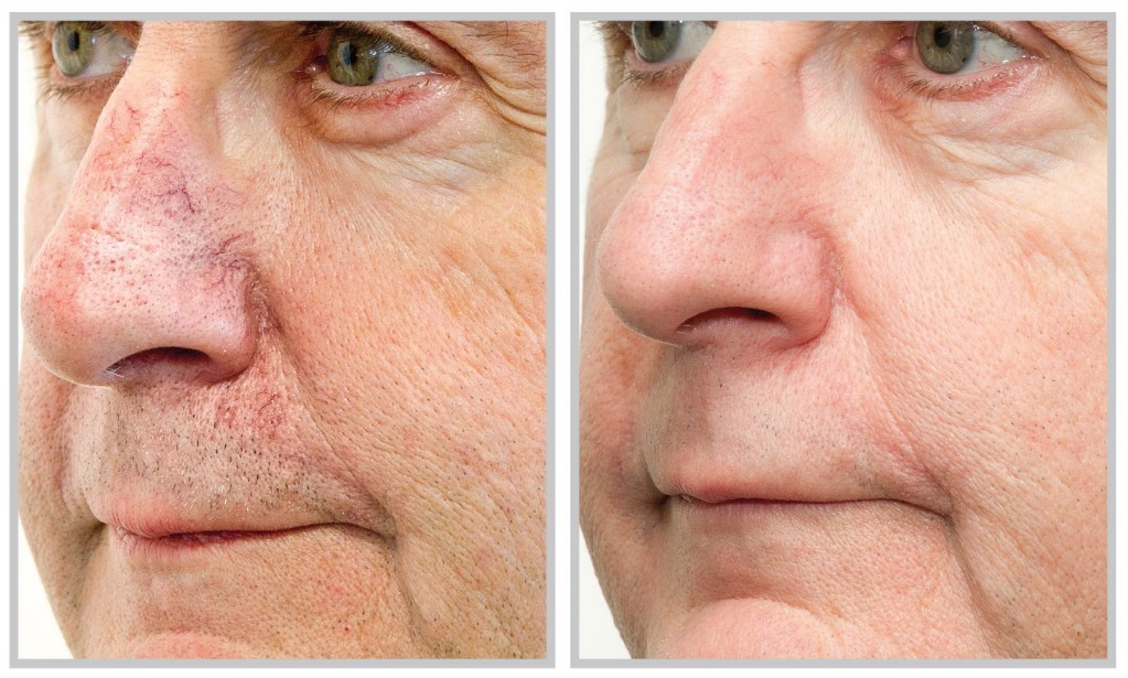Лечение сосудистых образований на лице (купероз) Зона крылья носа