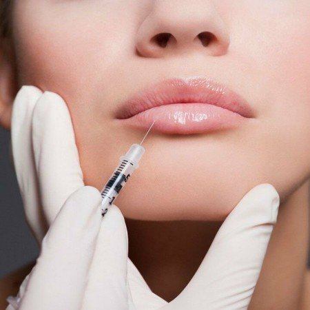 Увеличение губ препаратом Belotero Lips Contour (0,6 мл)