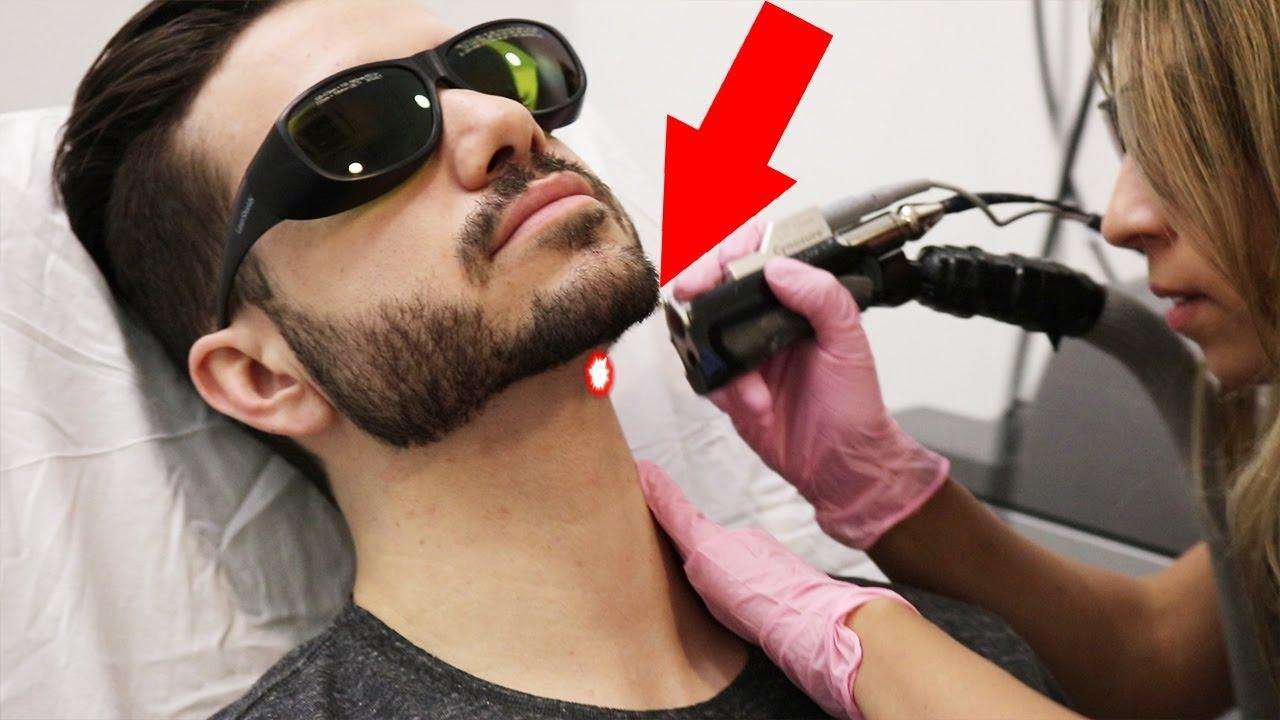Лазерная эпиляция для мужчин: коррекция контуров бороды