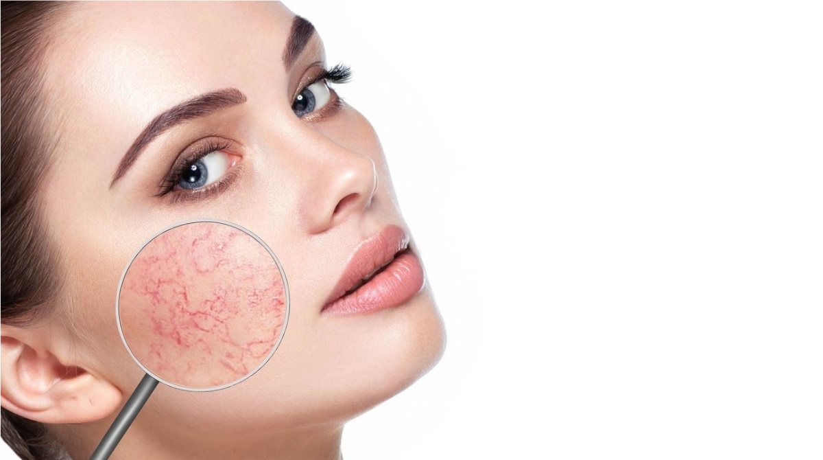 Лечение сосудистых образований на лице (купероз) щеки