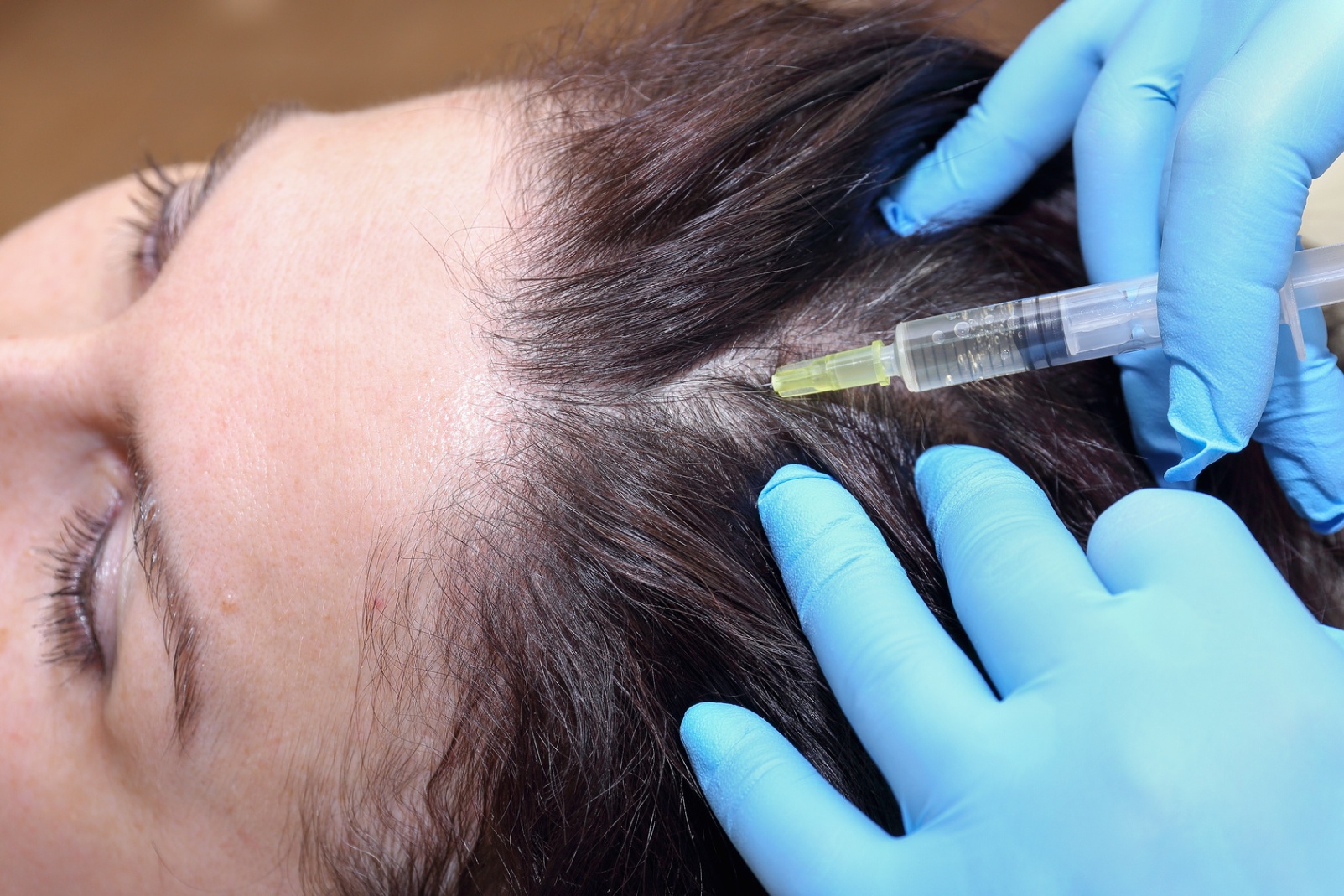 Мезотерапия против выпадения волос (комплексные коктейли) 