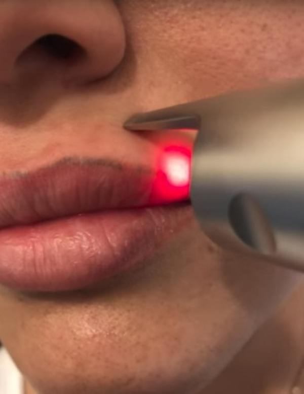  Удаление татуаж  на неодимовом лазере область  губы (в стоимость услуги включина анестезия.)