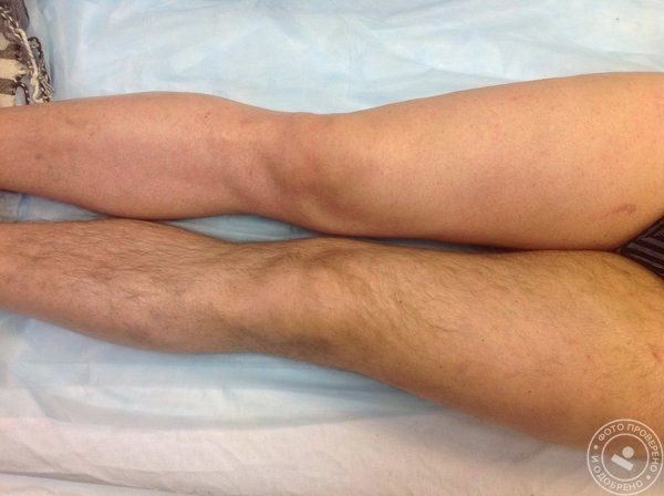 Лазерная эпиляция на аппарате Candela GentleMax: ноги мужские полностью