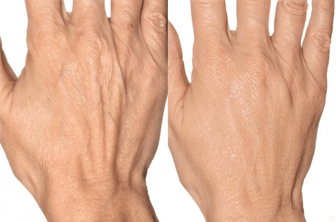 Фотоомоложение BBL (Skin Tyte): кисти рук