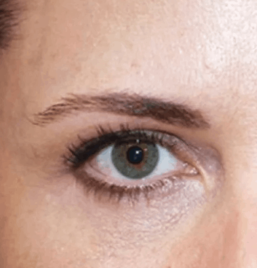 Микроигольчатый рф-лифтинг: зона вокруг глаз