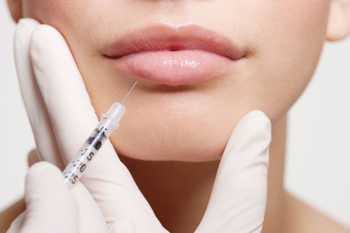 Увеличение губ препаратом Belotero Lips Shape 0,6 мл