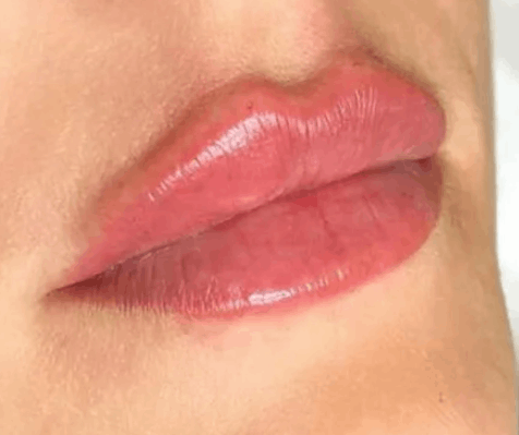 Увеличение губ препаратом Juvederm Ultra Smile (0,55мл)
