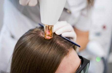 Лазерное омоложение: волосистая часть головы