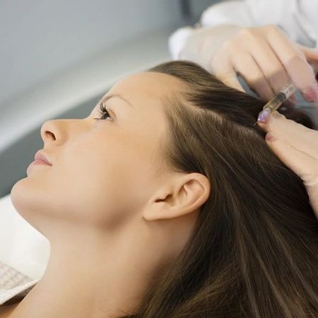 Мезотерапия волосистой части кожи головы (коктейль "Роскошные волосы") препаратом Mesoline HAIR