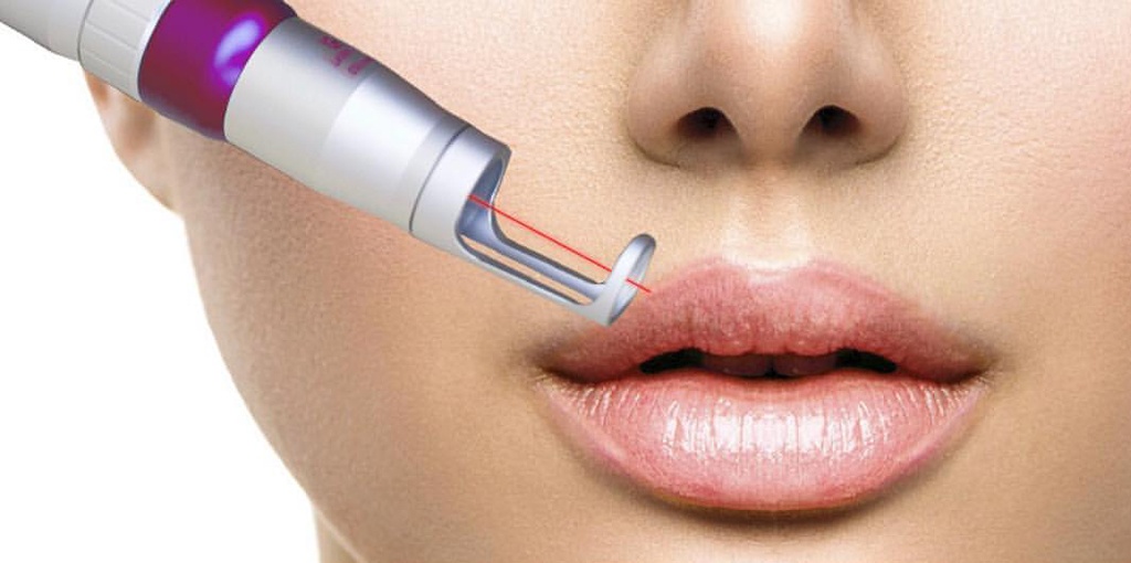 Удаления татуажа на неодимовом лазер губ частично (анастезия входит в стоимость)