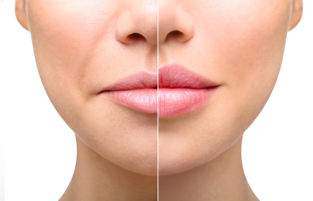 Smooth Lips - омоложение периоральной зоны и коррекции губ