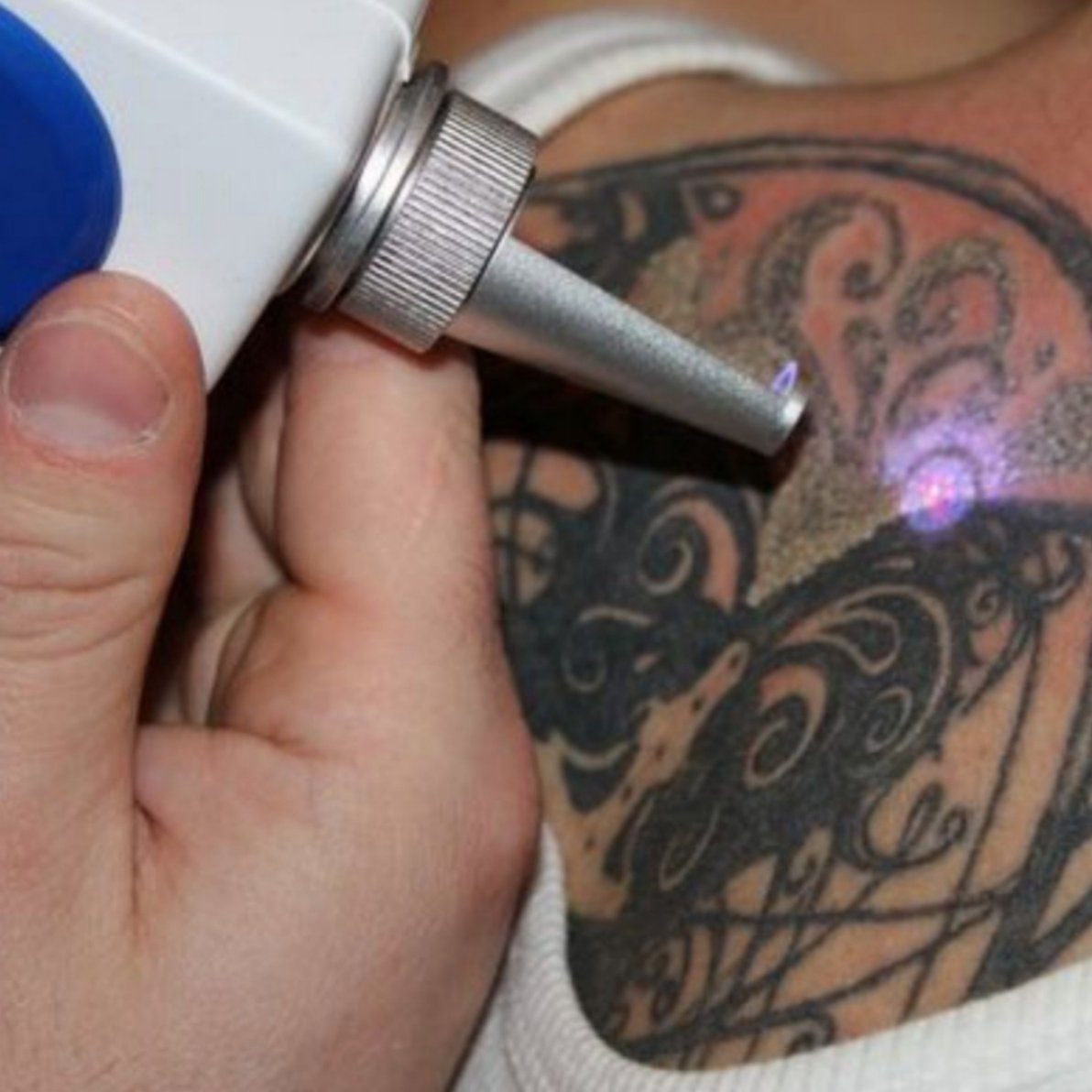 Удаление тату на неодимовом лазере  до 100 кв. см (в стоимость услуги включина анестезия.)