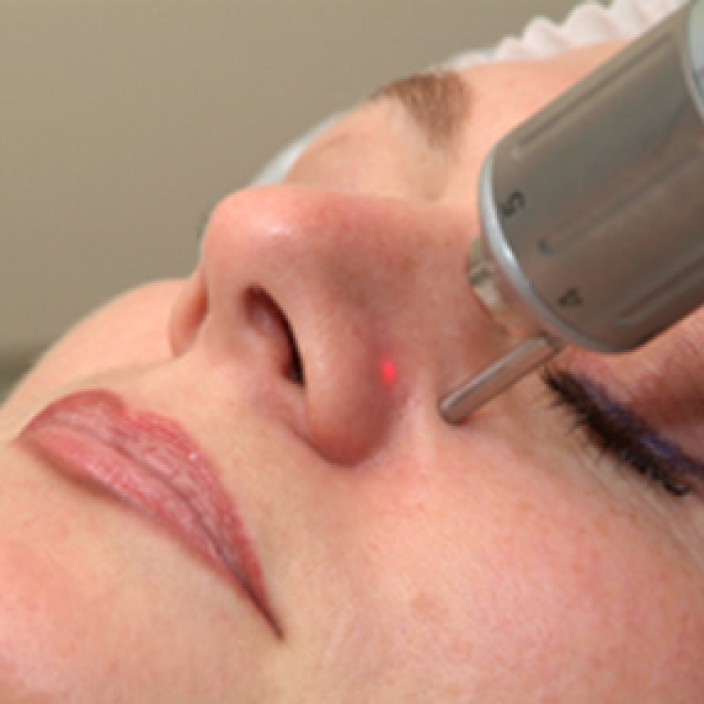 Лечение купероза на аппарате E-MAX технология ELOS: нос