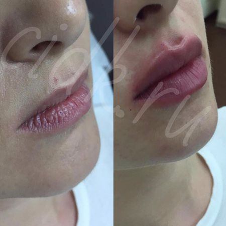 Увеличение губ препаратом Juvederm Ultra Smile (0,55 мл) 