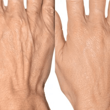 Фотоомоложение BBL (Skin Tyte): кисти рук