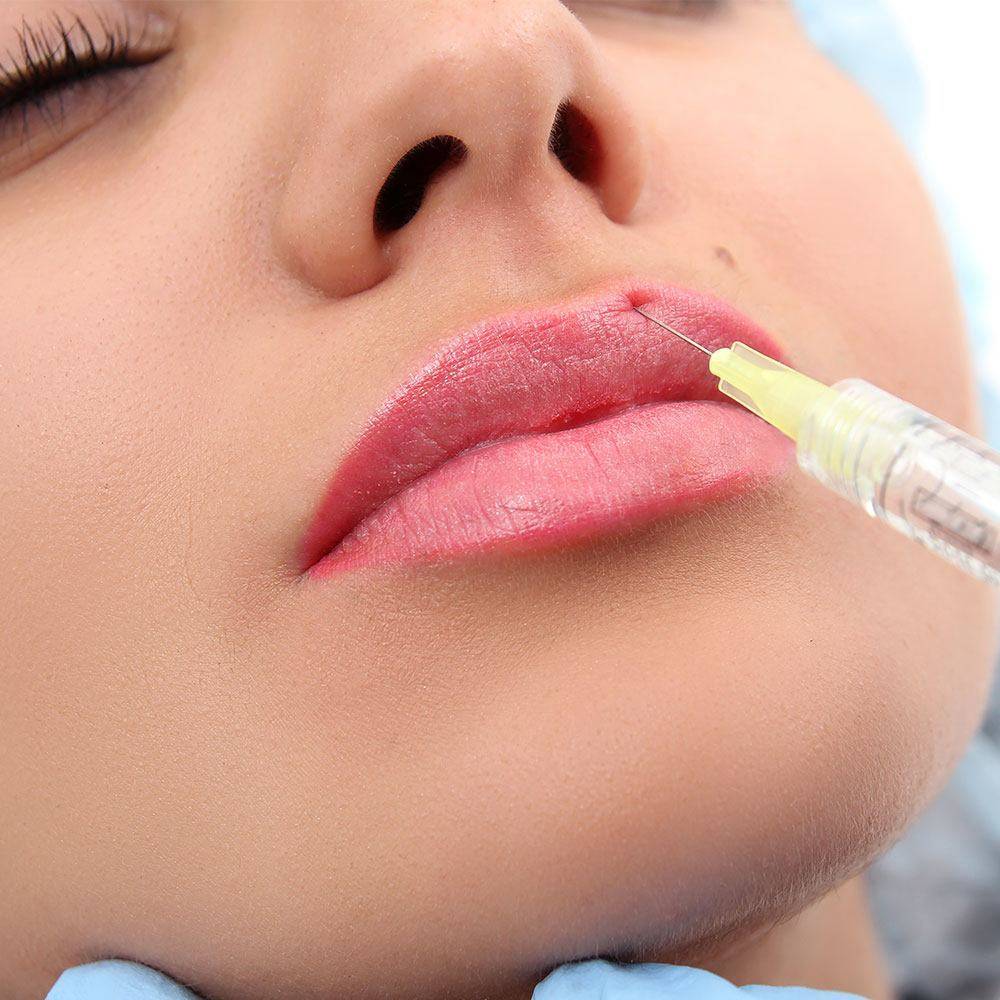 Увеличение губ препаратом Brilliance Derm (1 мл)