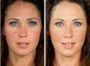 Лечение сосудистых образований на лице (купероз) лицо полностью