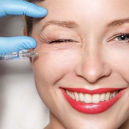 Контурная пластика препаратом Juvederm Volift (1 мл)