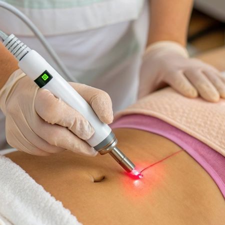 Фракционный фототермолиз рубцов до 1см2