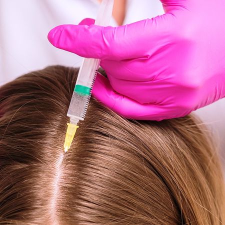 Мезотерапия препаратом Hair X Peptid (1,3 мл) : волосистая часть кожи головы