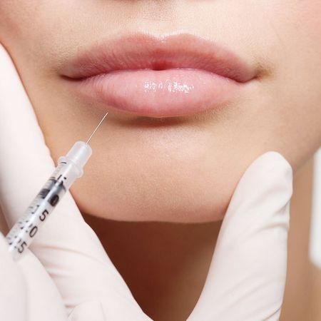 Увеличение губ препаратом Juvederm Ultra 3 (1 мл)