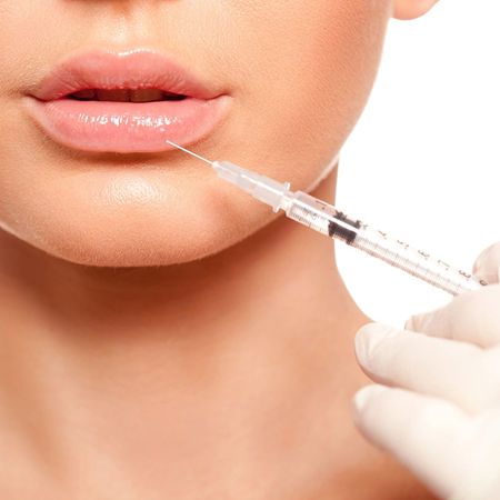 Увеличение губ препаратом HyaMax Lips (1 мл)