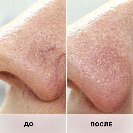 Лазерное омоложение (сосуды): нос