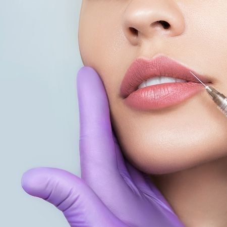 Увеличение губ препаратом Juvederm Ultra Smile (0,55мл)