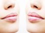 Увеличение губ Belotero Lips Shape (0,55 мл)